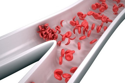 L-glutamina na crise de dor da anemia falciforme, ensaio clínico publicado pelo The New England Journal of Medicine (NEJM)