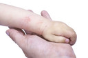 Dermatite atópica foi associada ao aumento do risco de doença inflamatória intestinal em adultos e crianças