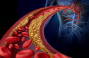 Estudo sugere que o evinacumabe reduz o colesterol LDL em 50% na hipercolesterolemia refratária